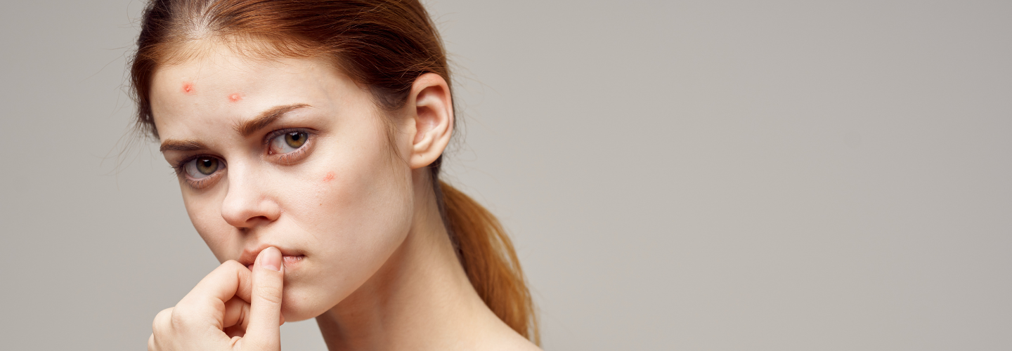 Achieve AcneFree Skin How Does Isotretinoin Treat Acne? — Articles