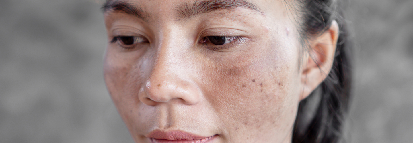Hydroquinone for Melasma Your GoTo Topical Treatment — Articles — We Care For Skin