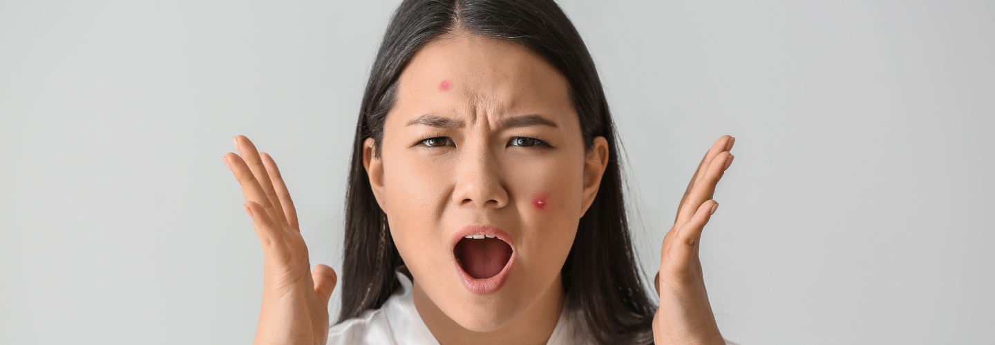 Does Summer Heat Cause Pimples — Articles — We Care For Skin