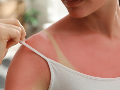 Sunburn Moisturizer: Tips to Prevent Sunburn in Summer