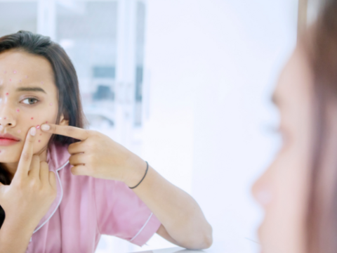 Acne 101: What is the Difference Between Acne and Pimple