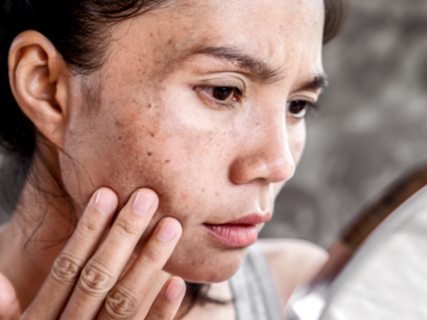 How to Cure Melasma from the Inside