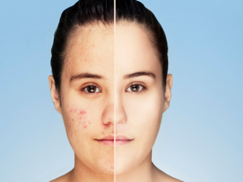  Isotretinoin Journey: Acne Success Stories From Breakouts to Clear Skin 