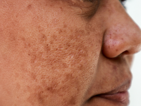 Can Hyperpigmentation Be Treated? 