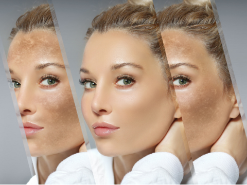 12 Medical Treatments for Melasma in 2023