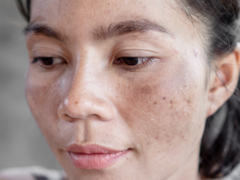Hydroquinone for Melasma: Your Go-To Topical Treatment
