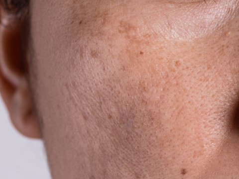 Say Goodbye to Brown Spots on Skin with These Top Treatments in 2024