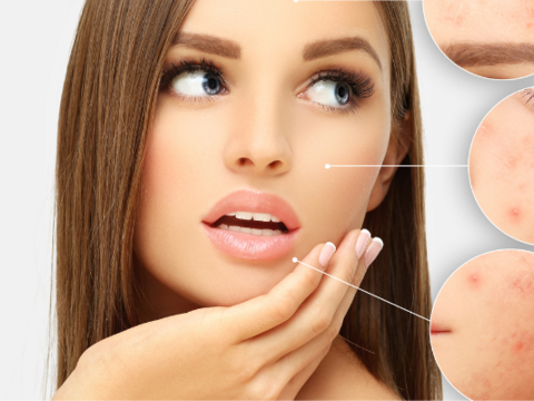 Acne 101: Acne Face Map and Solutions