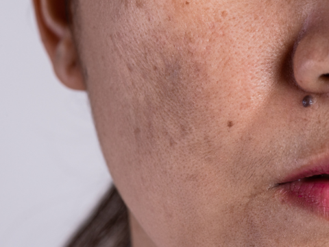 Melasma: Sanhi, Solusyon, at Pag-aalaga ng Pekas sa Mukha