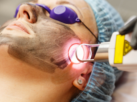 Can Diamond Peel Remove Melasma? Here's What We Know!