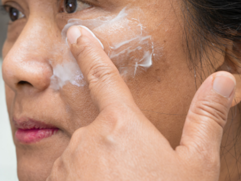 How to Remove Melasma Naturally: 14 Tips to Know!