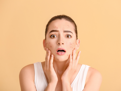 Acne Do’s and Don’ts: Debunking Common Myths in the Philippines