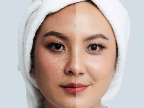 Treating Melasma From Within