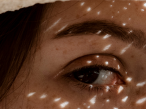 Sun Exposure: One of the Most Prevalent Causes of Melasma
