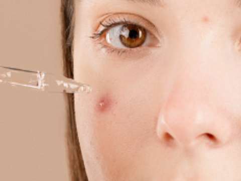 Tips for keeping acne under control 