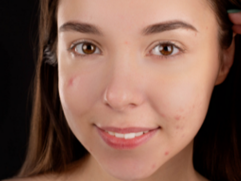 How Do You Treat Acne Scars