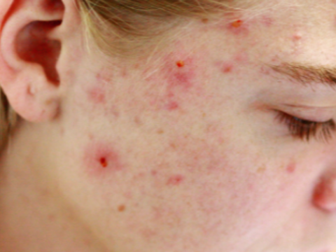 Using Isotretinoin the Right Way for Acne: Do’s and Don’ts 