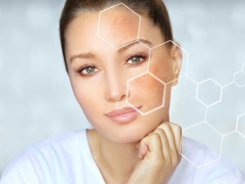Melasma as  One of the Common Diseases in Summer