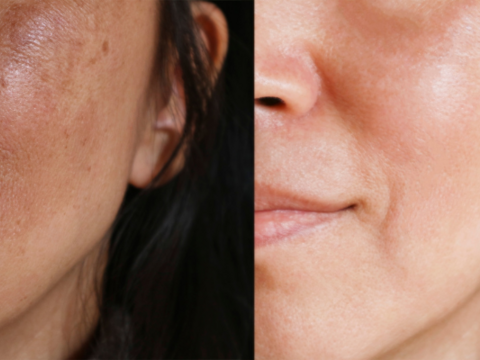 Tips to avoid getting melasma in the summer season