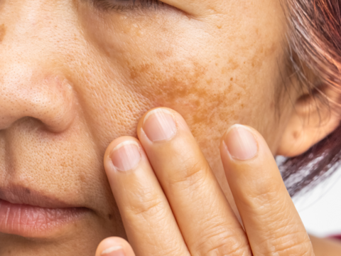 Does Procyanidin Work in Reducing Melasma Patches?
