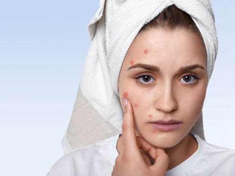 8 Acne-Fighting Ingredients to Prevent Break Outs