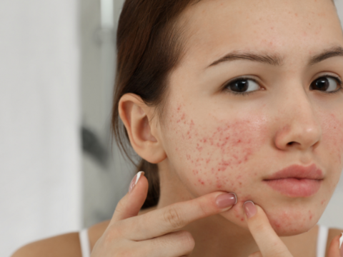 What Things Make Acne Worse